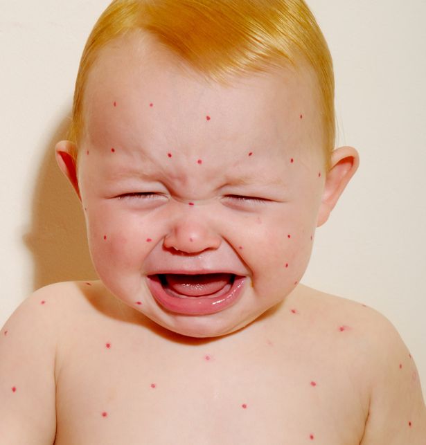 Small child with measels